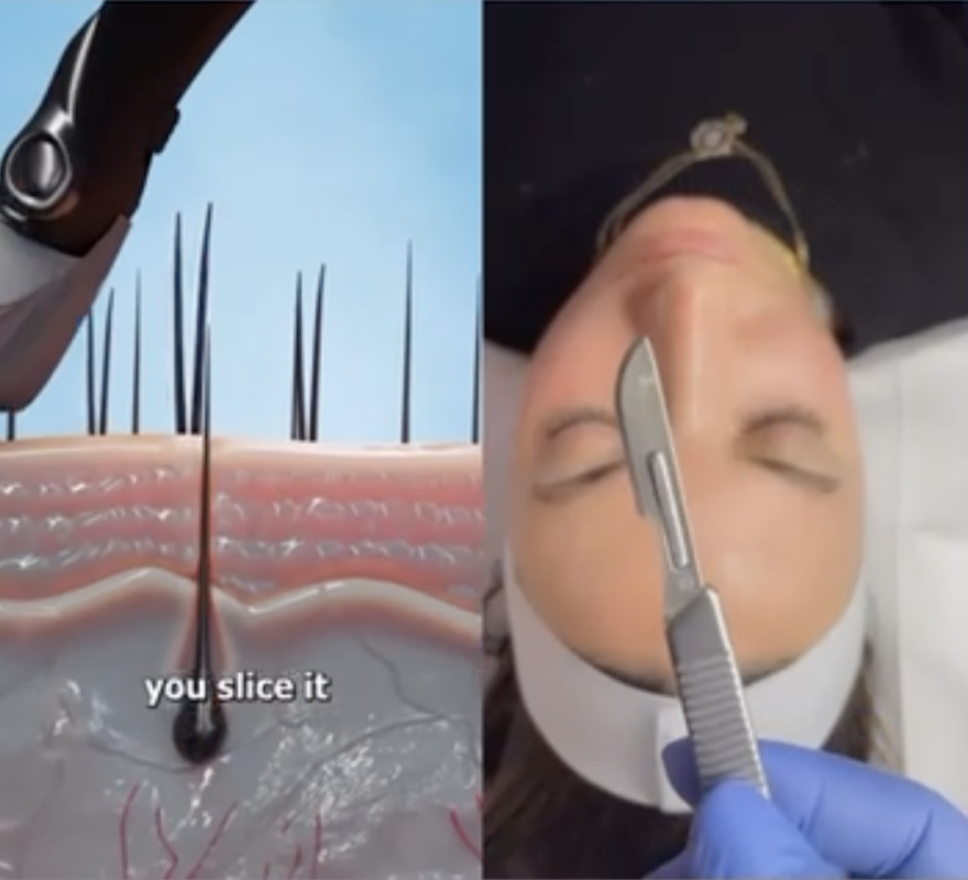 Laser hair removal